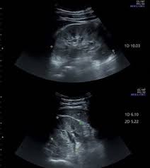 Bilateral Renal Parenchymal Disease - What Exactly Does It Mean?