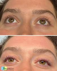 ✨Subtle lift, major impact ✨ This transformation was achieved using  Radiesse® to stimulate collagen and elastin in the mid-face and  chin—lifting, brightening, and improving projection. We also used  hyper-dilute Radiesse® to restore