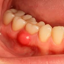 Image result for granuloma gum disease