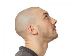 La micropigmentazione consente anche il camuffamento delle cicatrici. Tricopigmentazione Pigmentazione Dei Capelli Vicenza Padova Veneto Micropigmentazione Tatuaggio In Testa Cuoio Capelluto Pigmenti Colorati Soluzione Definitiva Calvizie 3 Vicenza Padova Milano Brescia Veneto Lombardia Treviso Venezia Verona Belluno