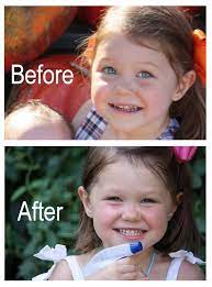 How I Reversed My Daughter S Tooth Decay Teeth Health Cure Tooth Decay Toddler Tooth Decay