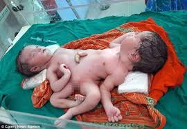 The girls are an incredible example of teamwork and compromise, as they. When One Conjoined Twin Dies Can The Other Be Salvaged Quora