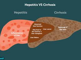 Download this premium vector about diagram showing cirrhosis of the liver, and discover more than 9 million professional graphic resources on freepik. Hepatitis And Cirrhosis Similarities And Differences