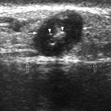 Although many unskilled observers would believe that size is a major issue, but it actually is not. Ultrasound Investigations In Head And Neck Cancer Patients Springerlink