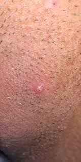 I get tested for stds regularly, so no stds. Herpes Or Ingrown Hair Genital Herpes Simplex Forums Patient