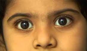 Moreover, sometimes children with cancer do not show any of these changes. Retinoblastoma Can Be Cured If Identified And Treated Early Ummid Com