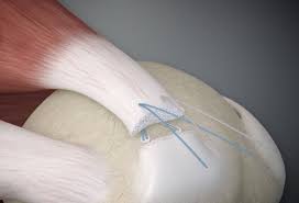 Hier erklären ärzte leicht verständlich begriffe aus medizinischen befunden. Rotatorenmanschettenriss Physiozentrum