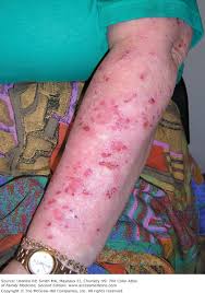 Image result for Neurotic Excoriation