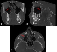 See more ideas about radiology, radiography, medical. Cbct Analysis Of Haller Cells Relationship With Accessory Maxillary Ostium And Maxillary Sinus Pathologies Springerlink