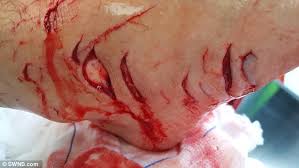 Résultat de recherche d'images pour "knife injuries"