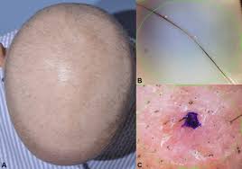 Is laser hair removal safe? Hair Disorders In Patients With Cancer Journal Of The American Academy Of Dermatology