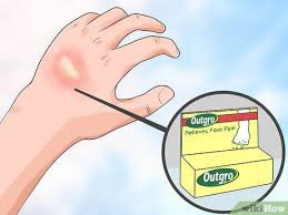 Maybe you would like to learn more about one of these? How To Take The Sting Out Of A Burn With Pictures Wikihow