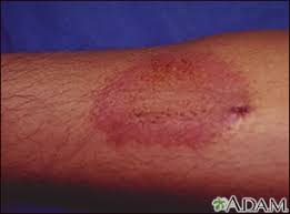 Image result for dermatitis contacta toxica
