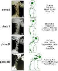 Cervical Spine What Can Happen Over Time If Subluxations Are Left Uncorrected Spinal Degeneration Text Neck Spine Health