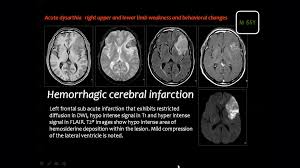 Cerebrovascular Imaging Radiology Lower Limb Pathology