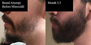 Both beard and mustache hair form after puberty. 3 Month Beard Update More Images And Description In Comments Amazing Results Minoxbeards