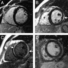 Cardiac mri is particularly useful because the iron overload directly affects magnetic resonance imaging classified as idiopathic, these cases are attributed to genetic factors, viral myocarditis. Cardiovascular Magnetic Resonance In Myocarditis A Jacc White Paper Sciencedirect