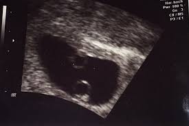 Ultraschallbilder Mehr Als 50 Bilder Aus Der Schwangerschaft Faminino