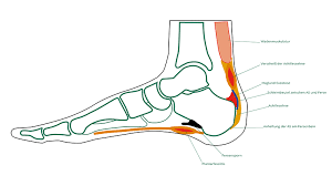 Haglund Exostose Ogam Orthopadie