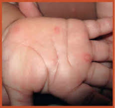 Syndrome pied main bouche contagion adulte vous eussiez rec u. Mon Enfant A Un Syndrome Pied Main Bouche Planete Sante