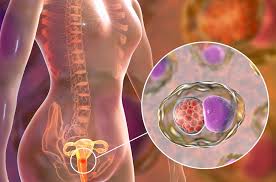 Different growth patterns may be seen for invasive cervical cancer, such as : Cervical Cancer Cervix Cancer Signs Diagnosis Treatment In Singapore Pcc Singapore