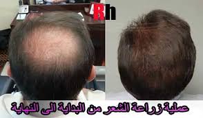 عملية زراعة الشعر من البداية وحتى النهاية Hair Transplant Hair Transplant