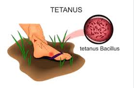 Image result for Tetanus