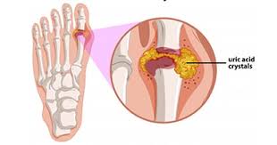 Grade 4 bone marrow cancer is an extensive bone marrow sarcoma with metastases or a diffuse form of myeloma. What Is Bone Marrow Cancer What Causes Bone Marrow Cancer