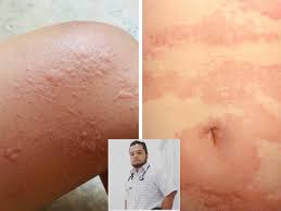 Titik merah pada gatal badan. Ini Bukan Kena Ludah Jin Ya Makin Garu Makin Merah Badan Doktor Jelaskan Ini Urticaria Remaja