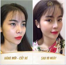 COMBO LÀM ĐẸP NÂNG MŨI + CẮT MÍ ƯU ĐÃI THÁNG 2