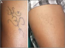 Download now 38 gambar sorotan terbaik di 2019 dekorasi instagram dan fotografi. A Prospective Open Labeled Study Of Tattoo Removal With Q Switched Nd Yag Laser Utilizing The R0 Technique And Correlation With Kirby Desai Scale Abstract Europe Pmc