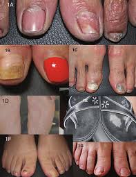 Image result for Onycholysis feet