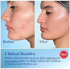 brandadvocacy #differingel #realskinstories #acneisreal #consumermarketing  #futureofbeauty