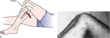 Image result for PCL Sulcus Test