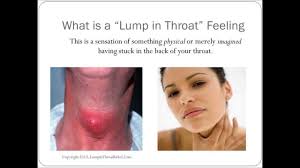 A lump in the neck may be a sign of thyroid cancer. Lump In Throat Feeling How To Get Rid Of Globus Hystericus Lump In My Throat Sensation