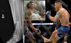 Chris weidman my story after breaking my leg episode 1 ufc pelea gratis: Ufc Star Chris Weidman Reveals Gruesome Pre Surgery X Ray Image Of His Double Leg Break Daily Mail Online