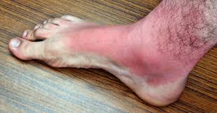 Check spelling or type a new query. Webmd Ø¹Ù„Ù‰ ØªÙˆÙŠØªØ± Severe Sunburn Or Sun Poisoning Can Cause Symptoms Beyond Skin Redness Or Discomfort What You Need To Know Https T Co Lwfymeyeta Https T Co 9xatk6oxqc ØªÙˆÙŠØªØ±
