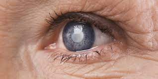 Find out more about this common disorder, including cataracts' visual effects, other symptoms, diagnosis and treatment. Cataract Grauer Star Augenarztpraxis Buttner Pforzheim