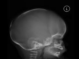 Image result for Skull XRay