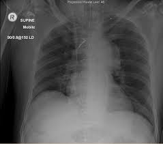 Systematic approach to the chest film using an inside out. A Chest Radiograph After Cardiac Surgery Intensive