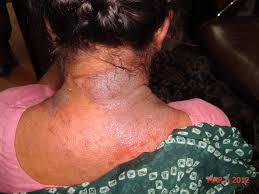 Image result for Photodermatitis