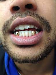 Dental crowns are caps placed on top of damaged teeth. Gold Grillz Grillz Gold Teeth Gold Grillz