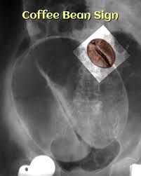 Image result for Sigmoid Volvulus