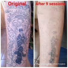 Harry Potter Sleeve Laser Tattoo Removal Laser Tattoo Tattoo Removal