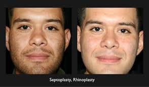 Rhinoplasty Beverly Hills Ca Rhinoplasty Face Procedures Plastic Surgery