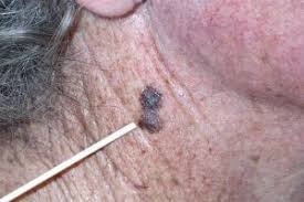 Yes, skin cancer can be itchy. What Does Skin Cancer Look Like U S Dermatology Partners Blog