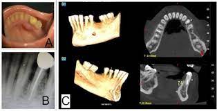 Lateral Periodontal Cyst A Diagnostic Dilemma Report Of A Rare Case With Cbct And Histological Findings Sciencedirect