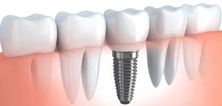 In north carolina, 50% of the cost is covered. How Much Does A Dental Implant Cost In Toronto On