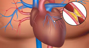 Recommended for most arthritis patients.* Yoga For Heart Disease Archives Eyogaguru Com
