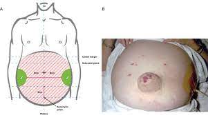 How to measure abdominal girth ascites. Guidelines On The Management Of Ascites In Cirrhosis Gut